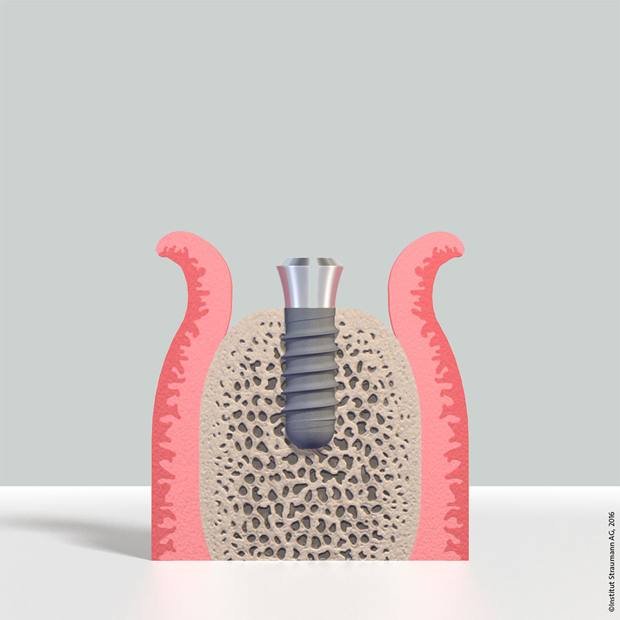Implantat